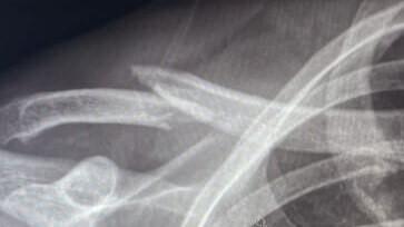 Sleutelbeen fractuur